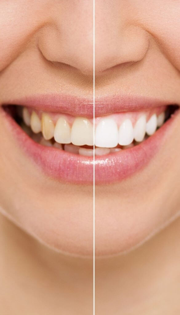 Before and After teeth cleaning | Featured Image for the Dental Services Page of Restore Dental.